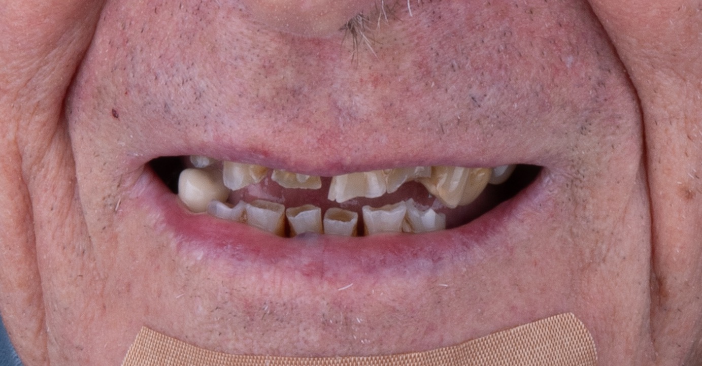 Severely worn smile before restorative treatment