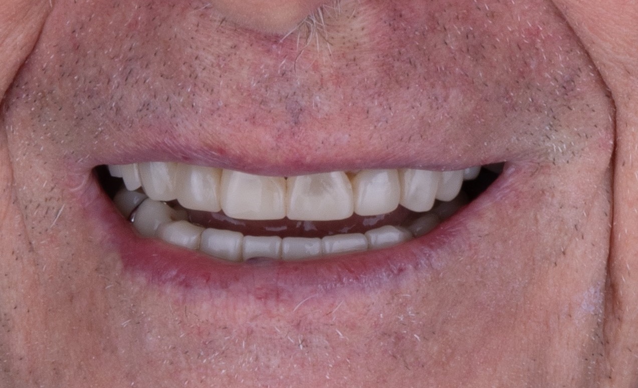 Restored smile after conservative bonded treatment