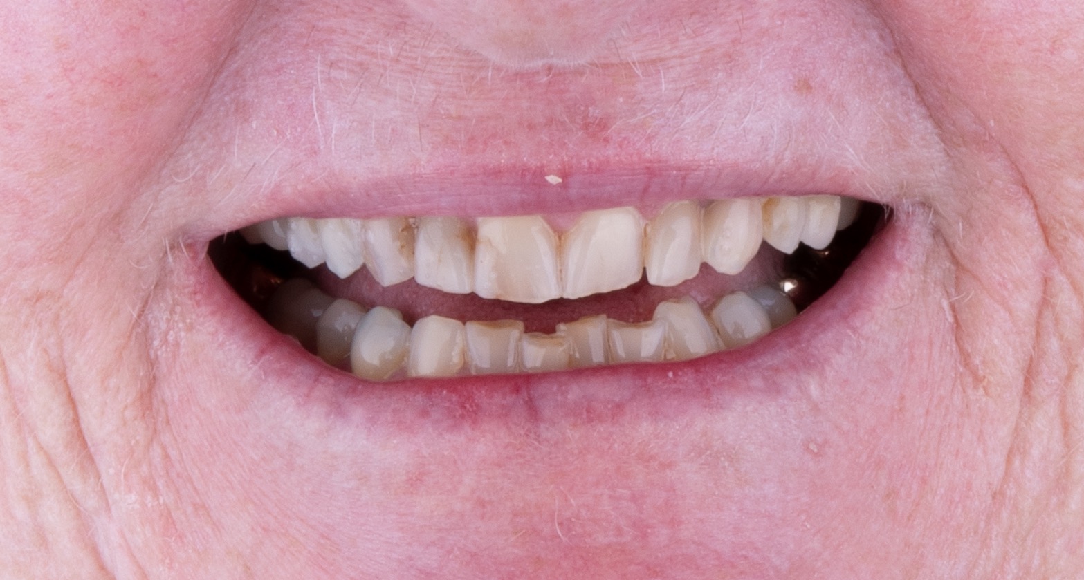 Worn smile before treatment