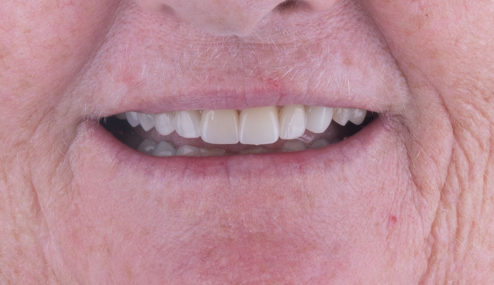 Smile after restorative treatment