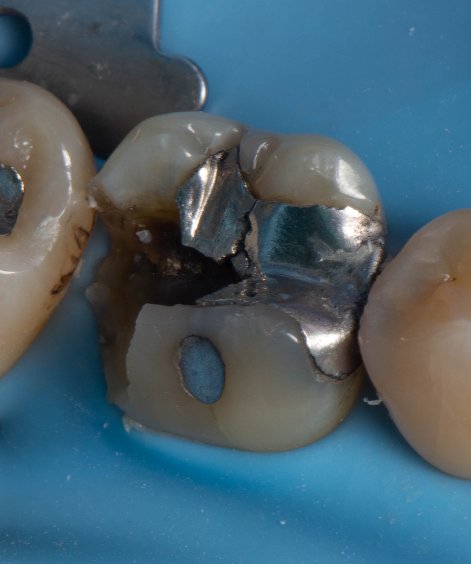 Broken tooth before treatment