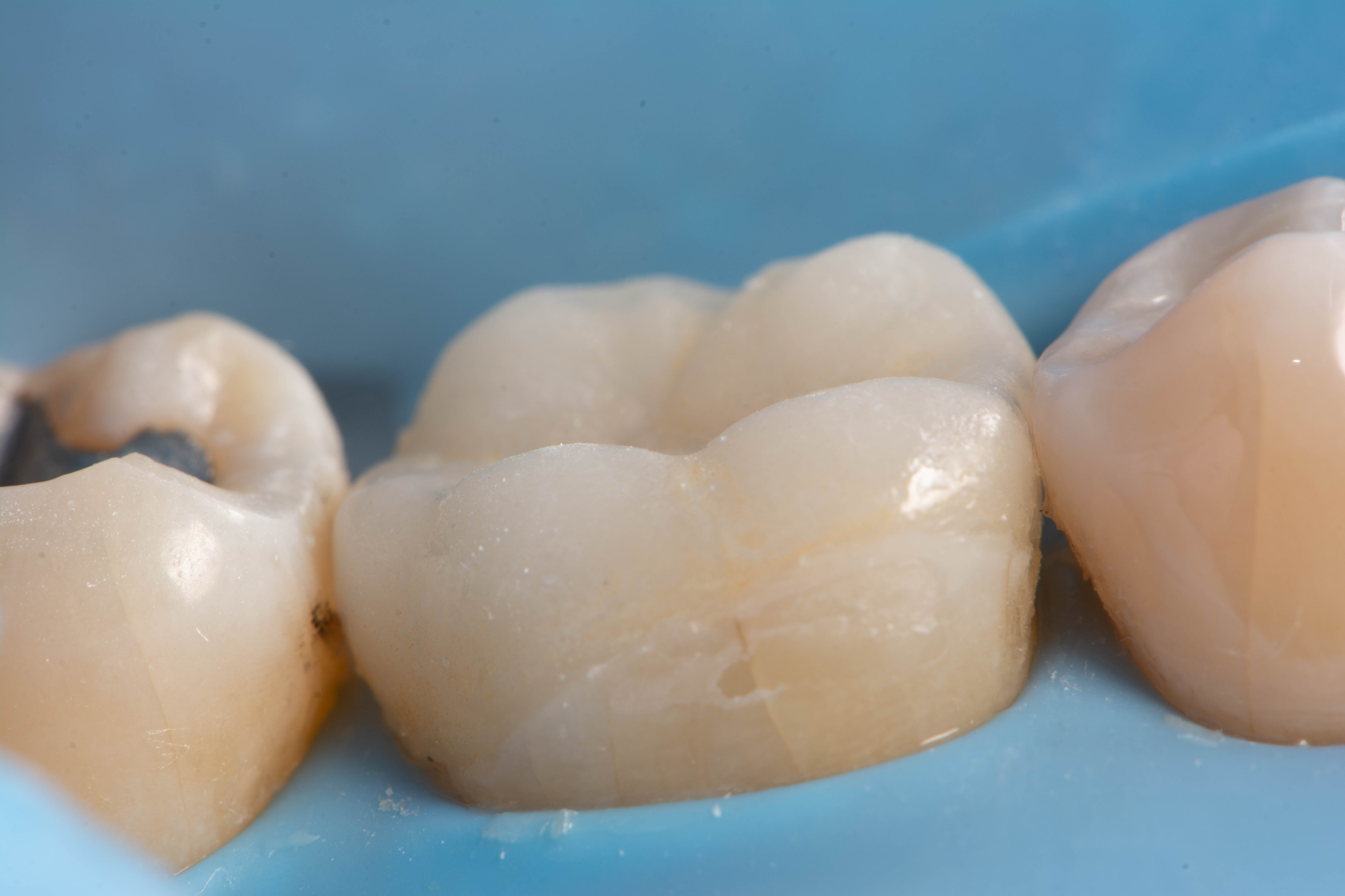 Final bonded porcelain restoration