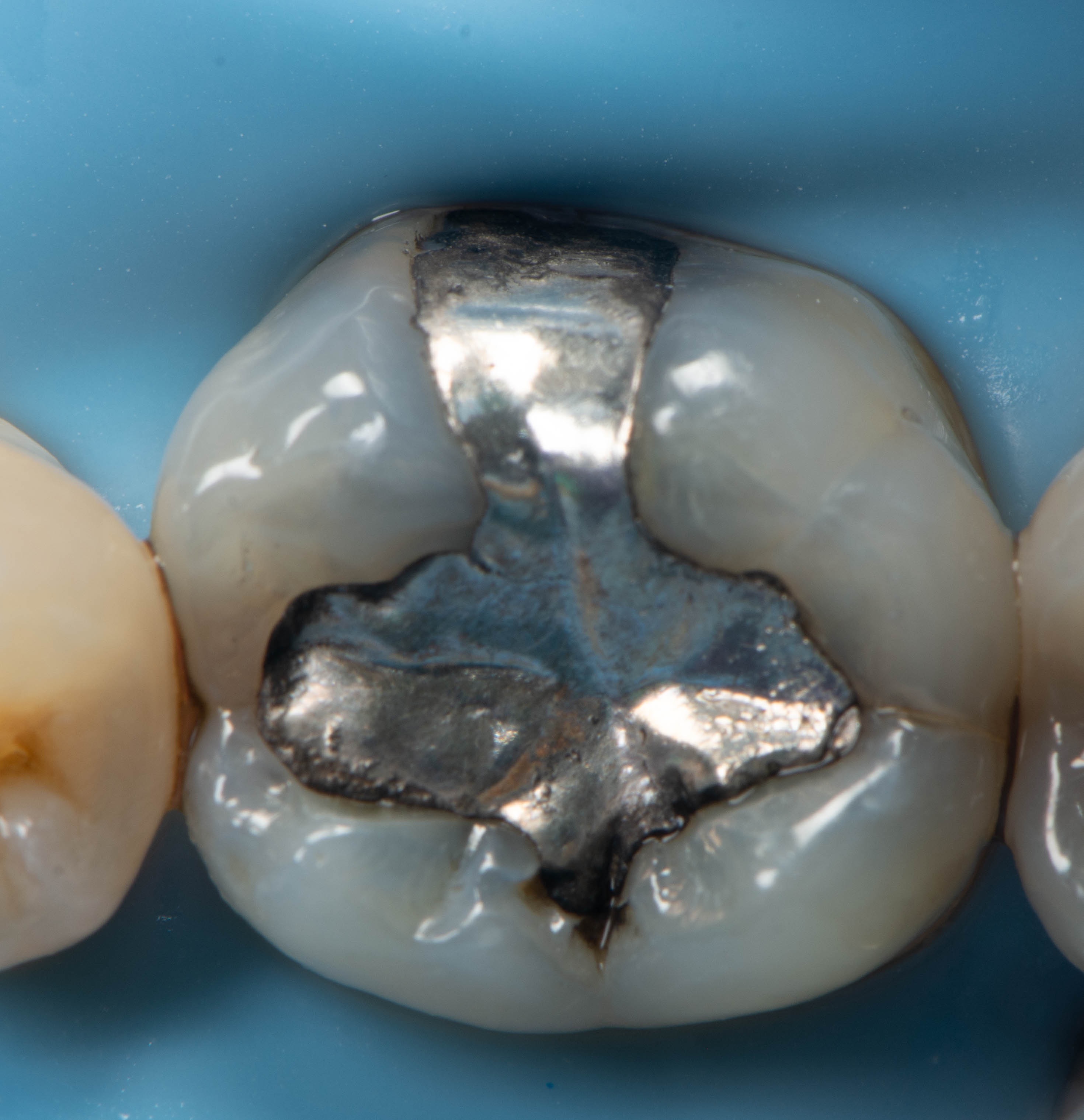 Large silver filling before treatment
