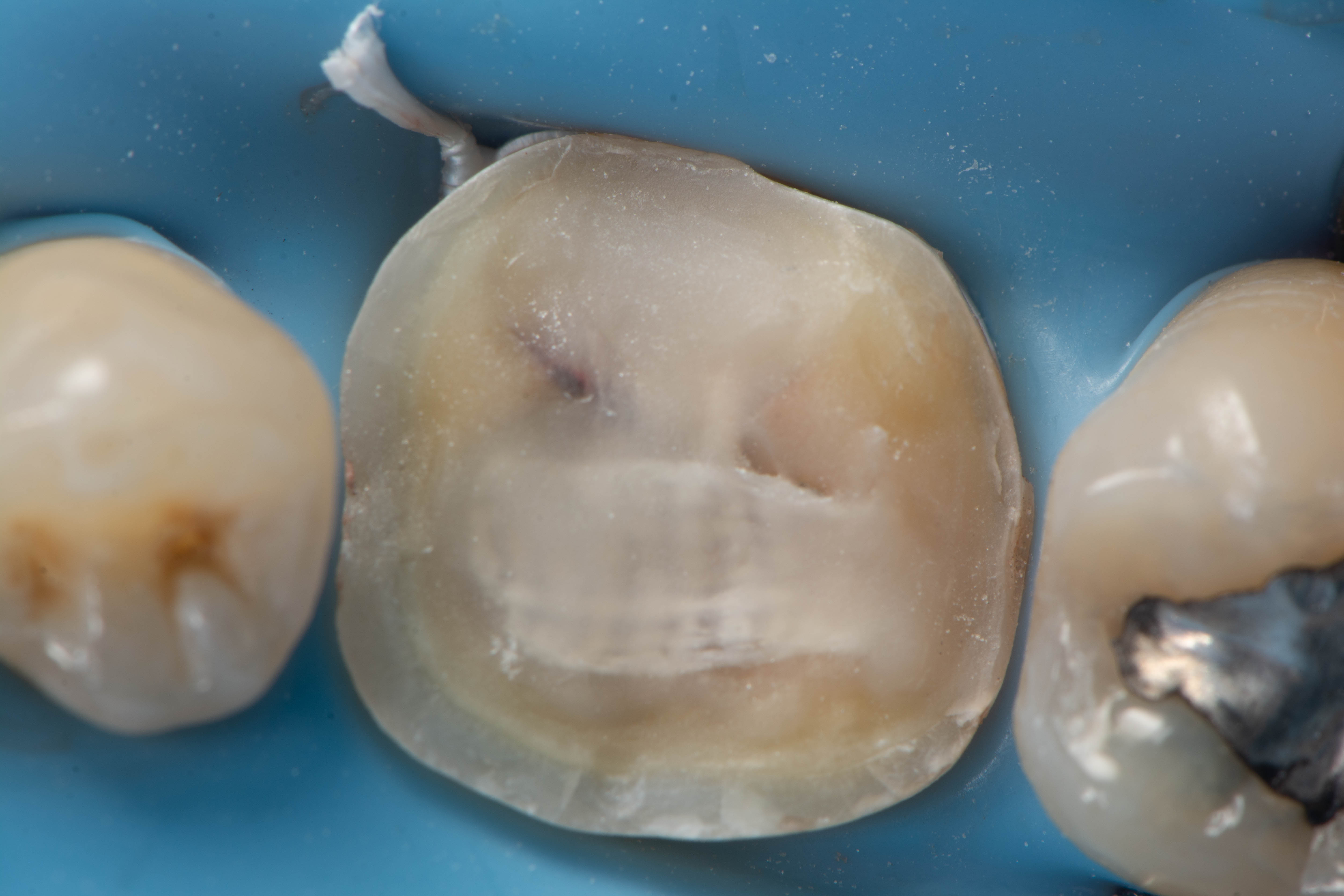 Fiber reinforcement stabilizing the tooth