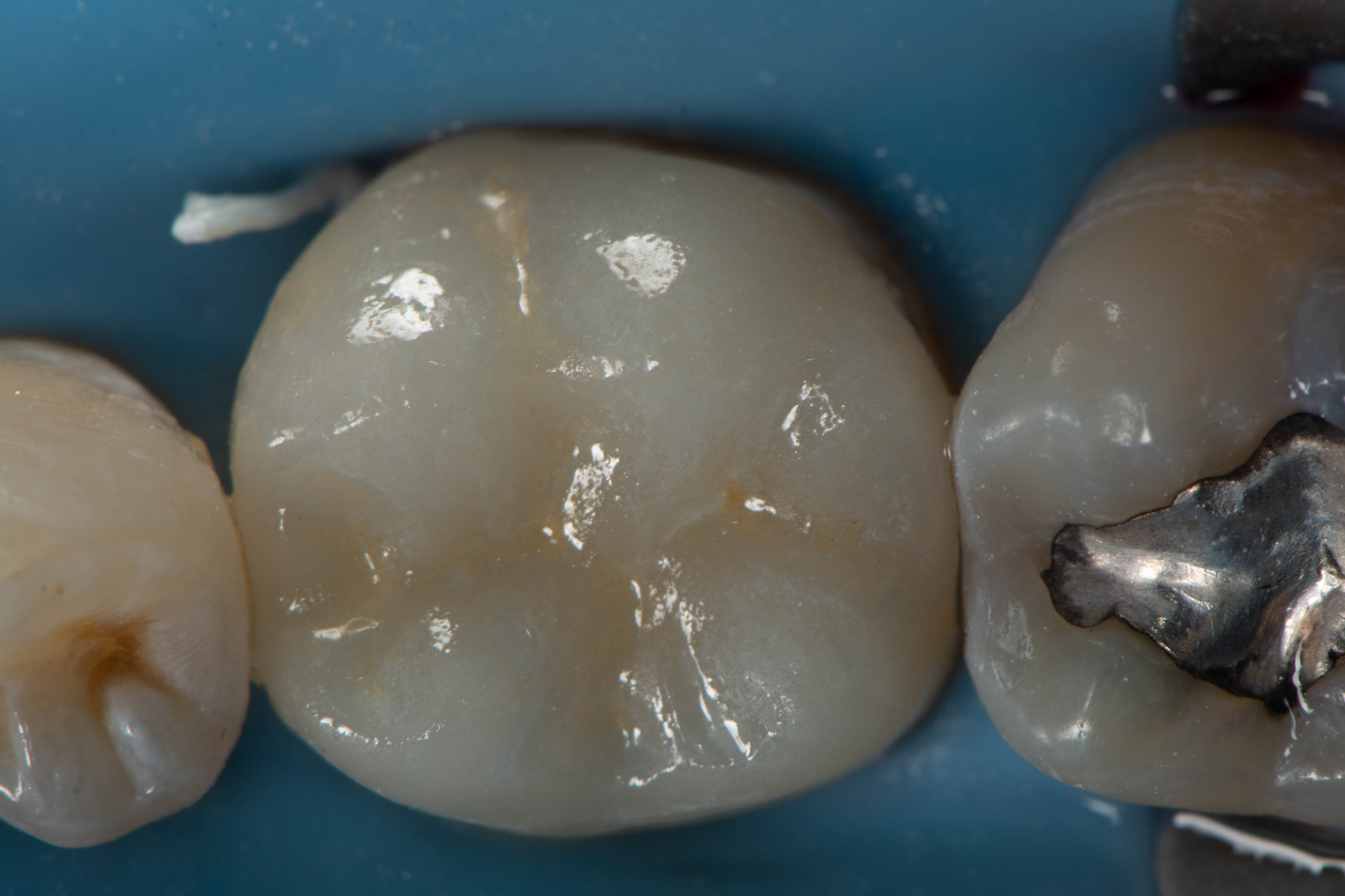 Final bonded restoration