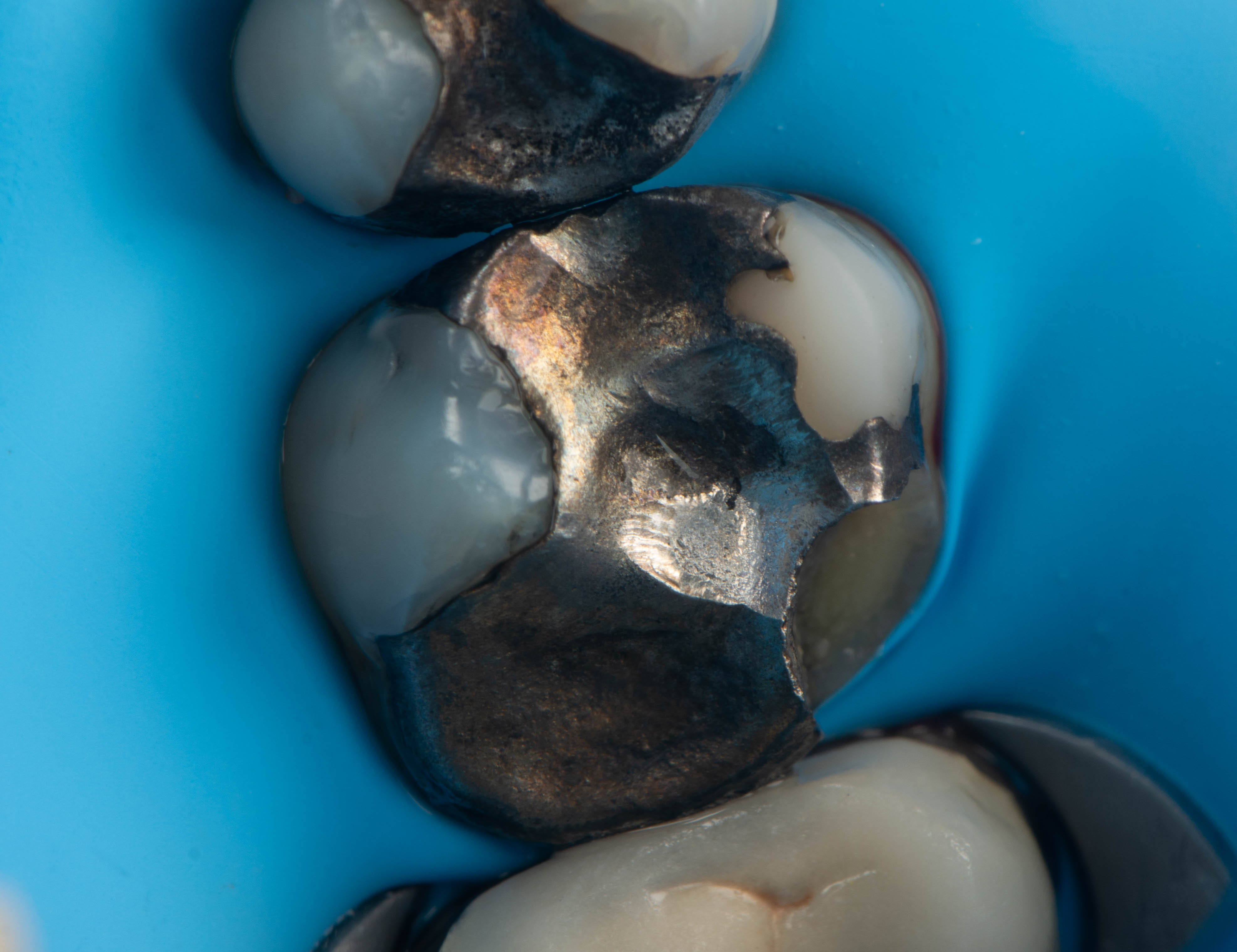 Large silver filling before treatment