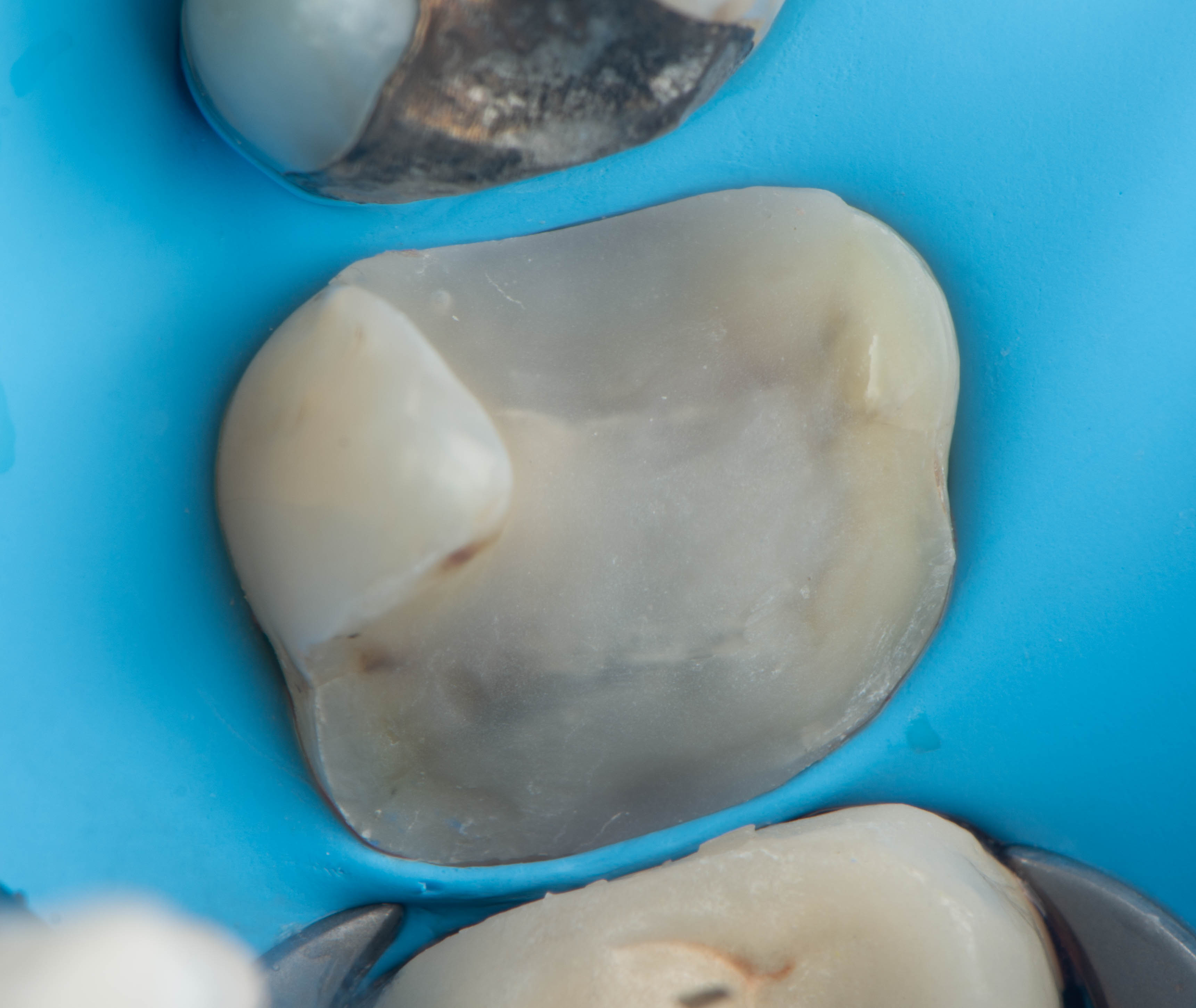 Fiber reinforcement placed within the tooth