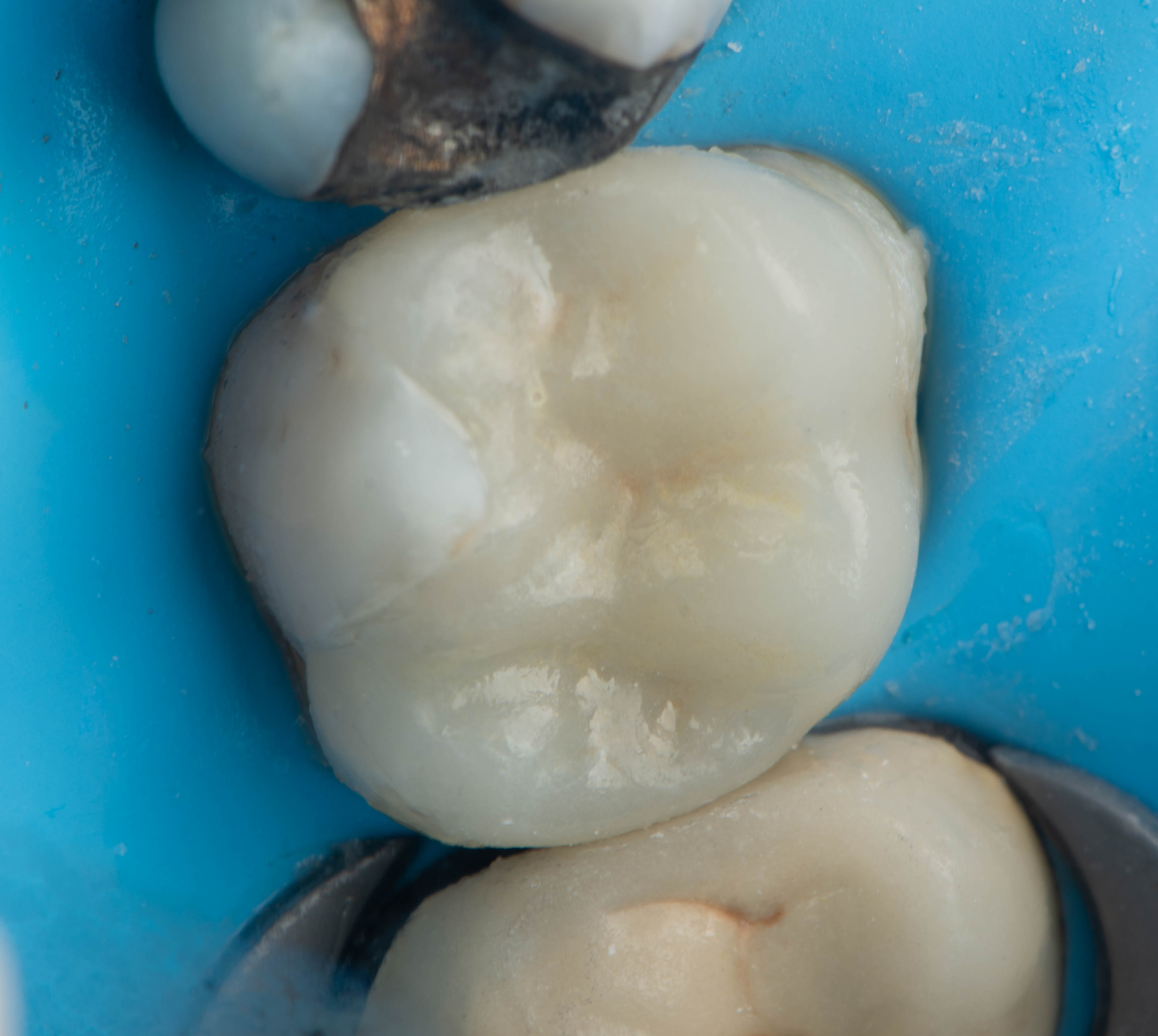 Final tooth-colored restoration