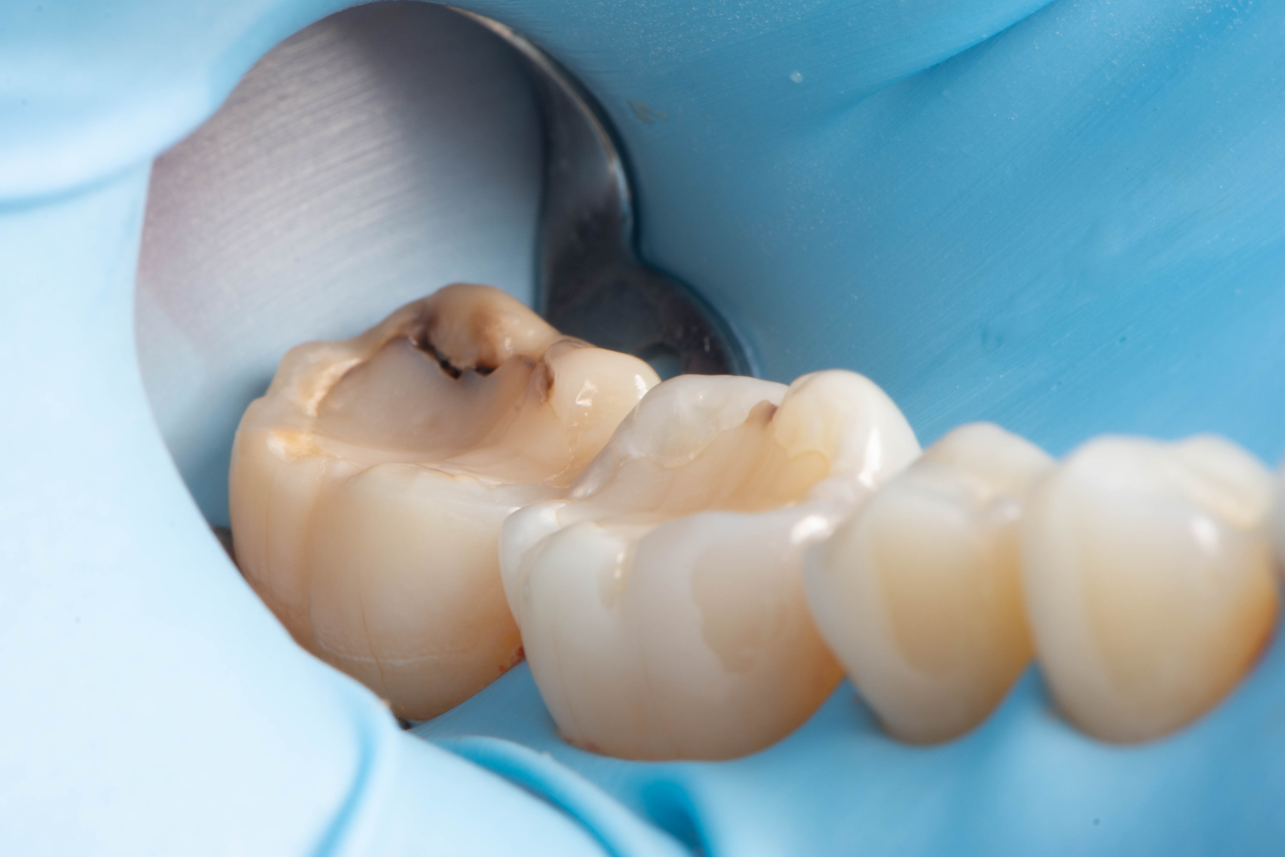 Failing tooth-colored filling