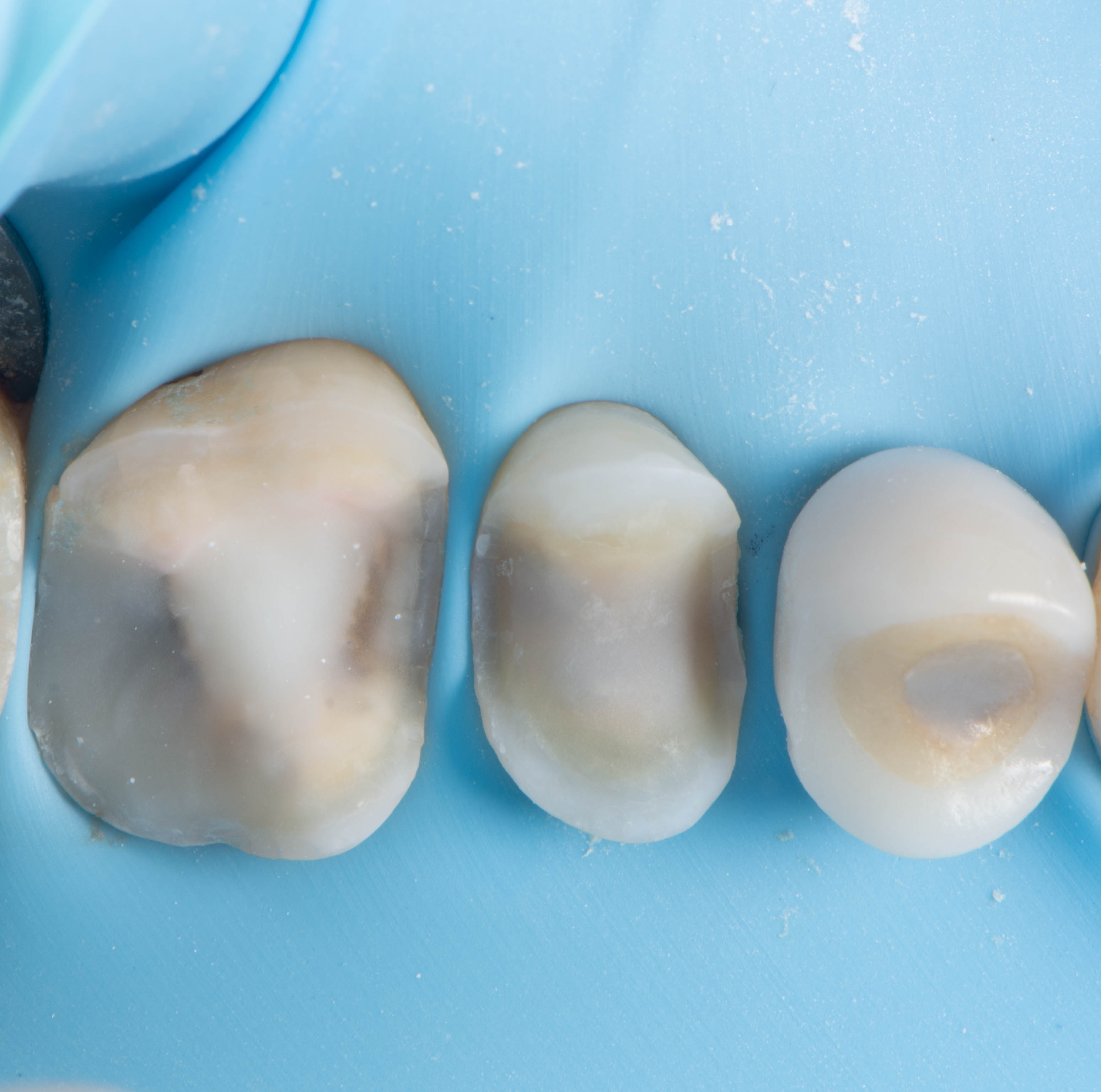 Conservative preparation before restoration