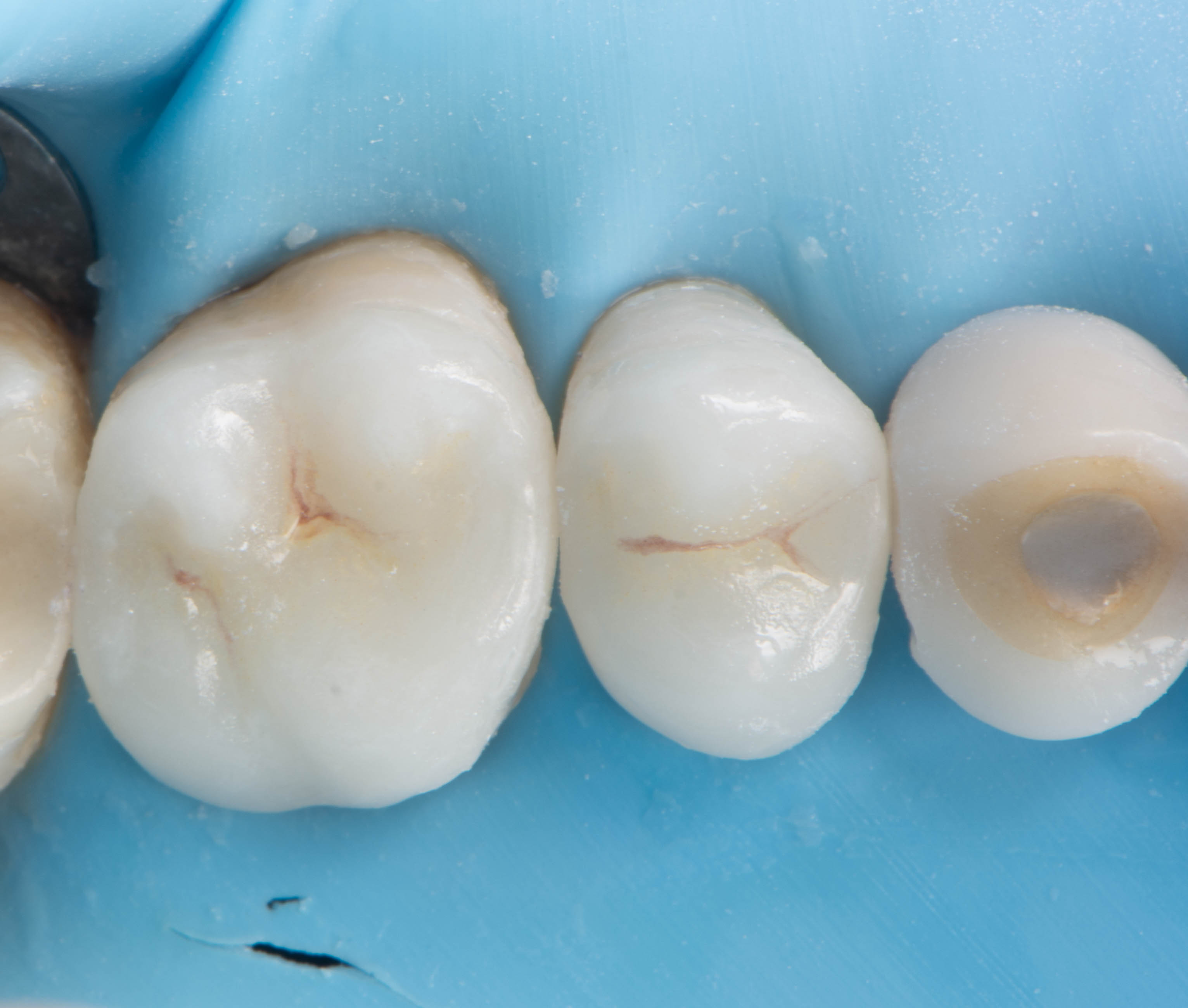Bonded restorations after placement