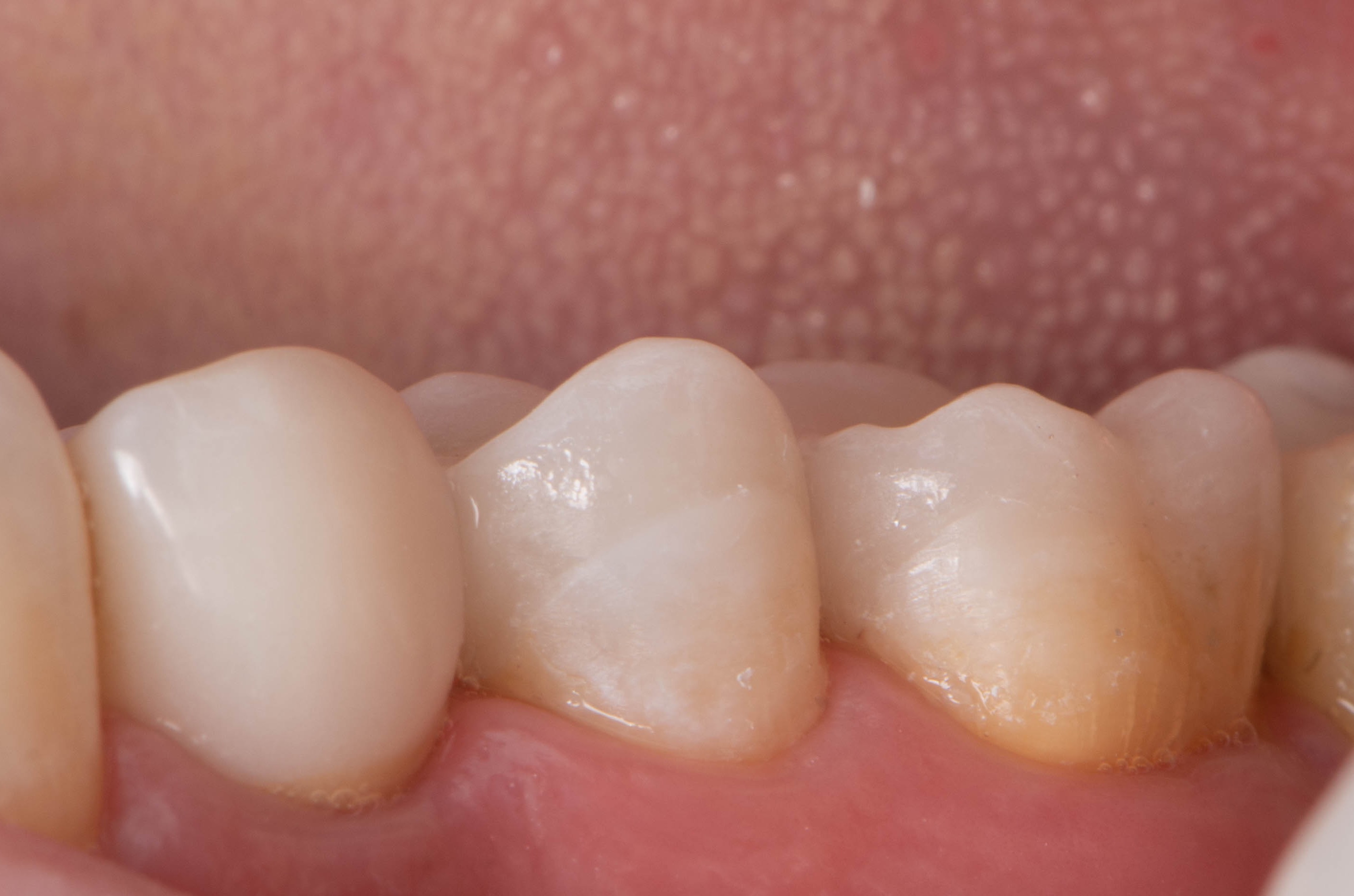 Natural appearance of the completed restorations