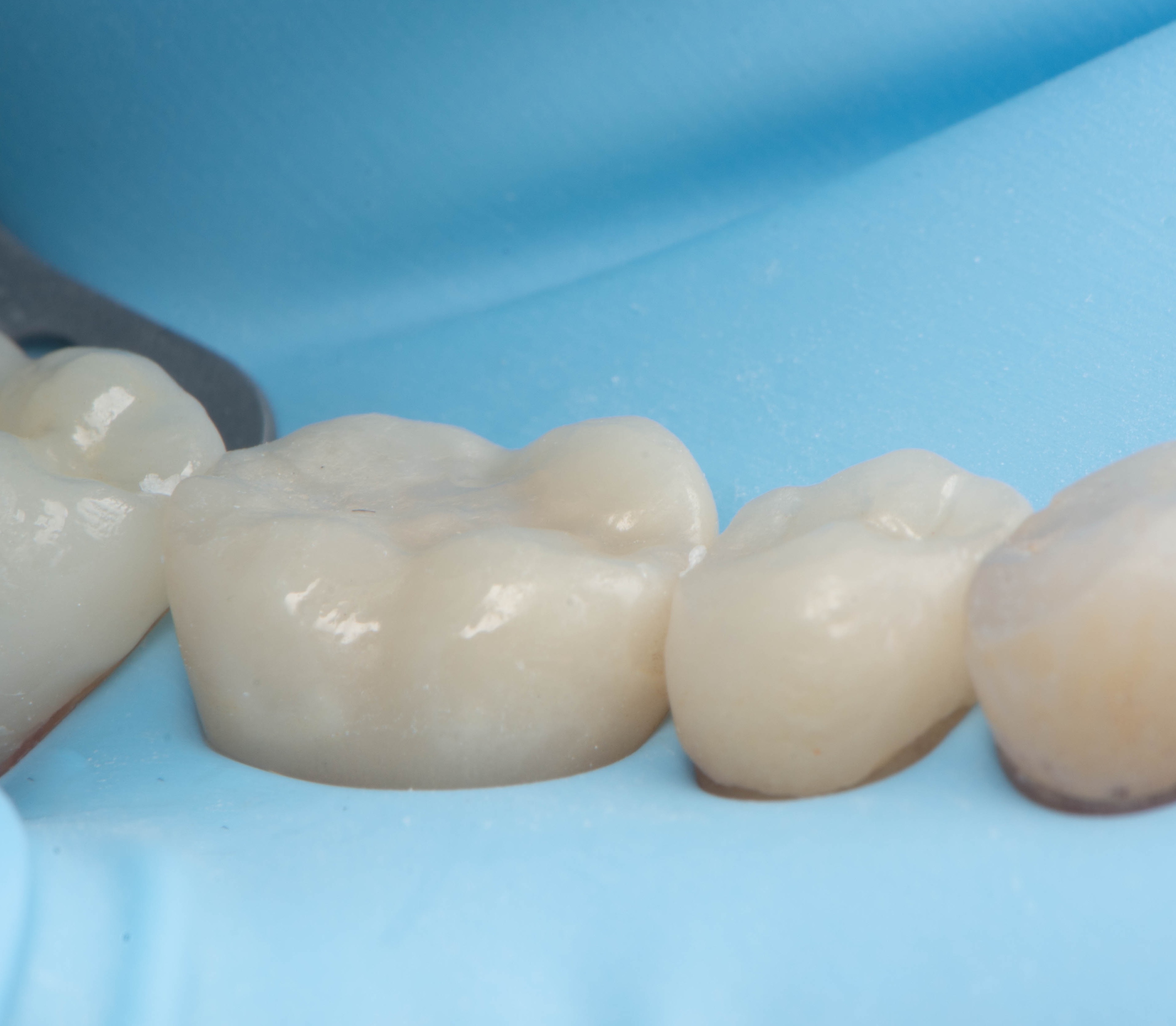 Traditional crown before removal