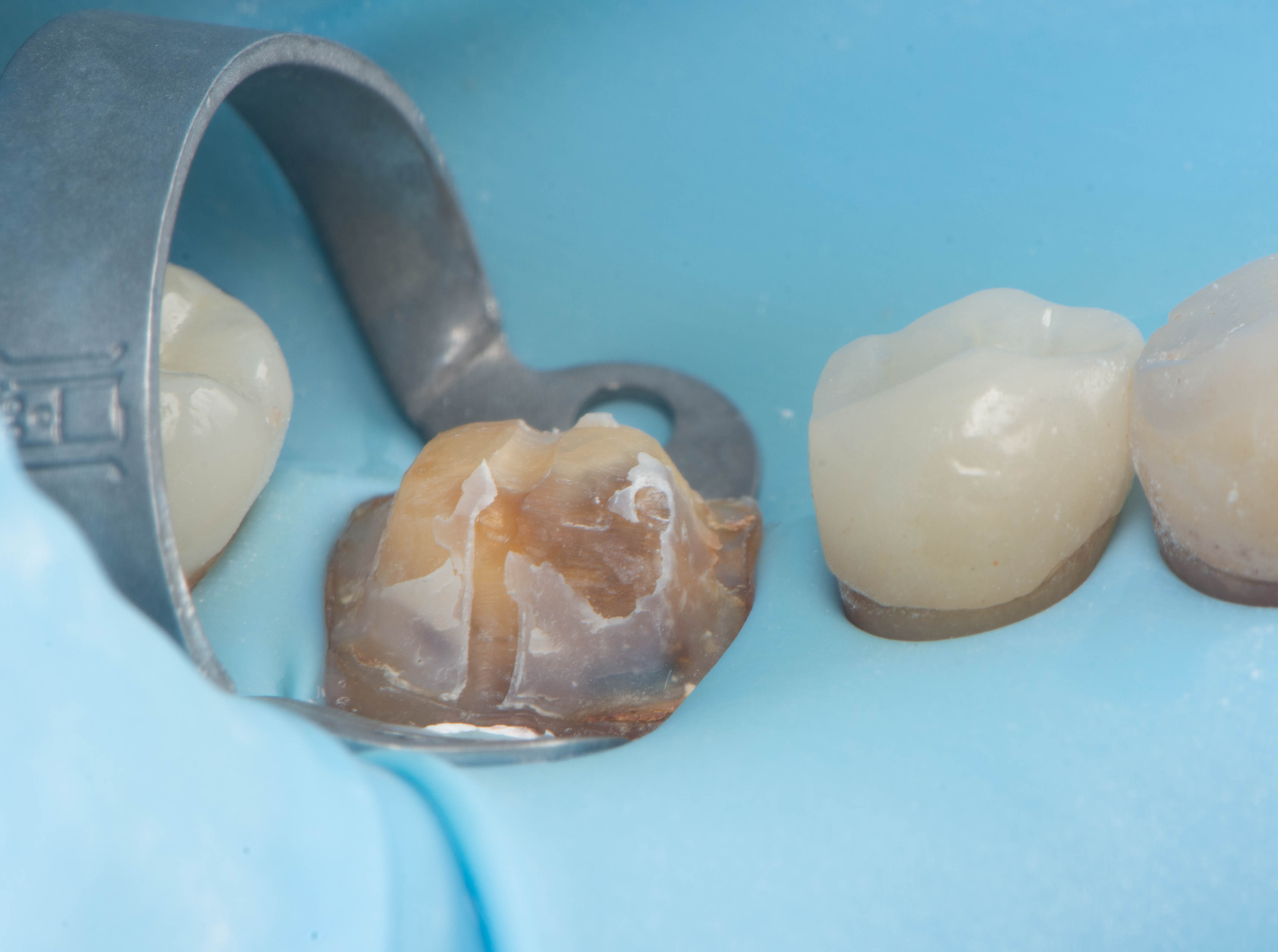 Tooth immediately after removal of the old crown