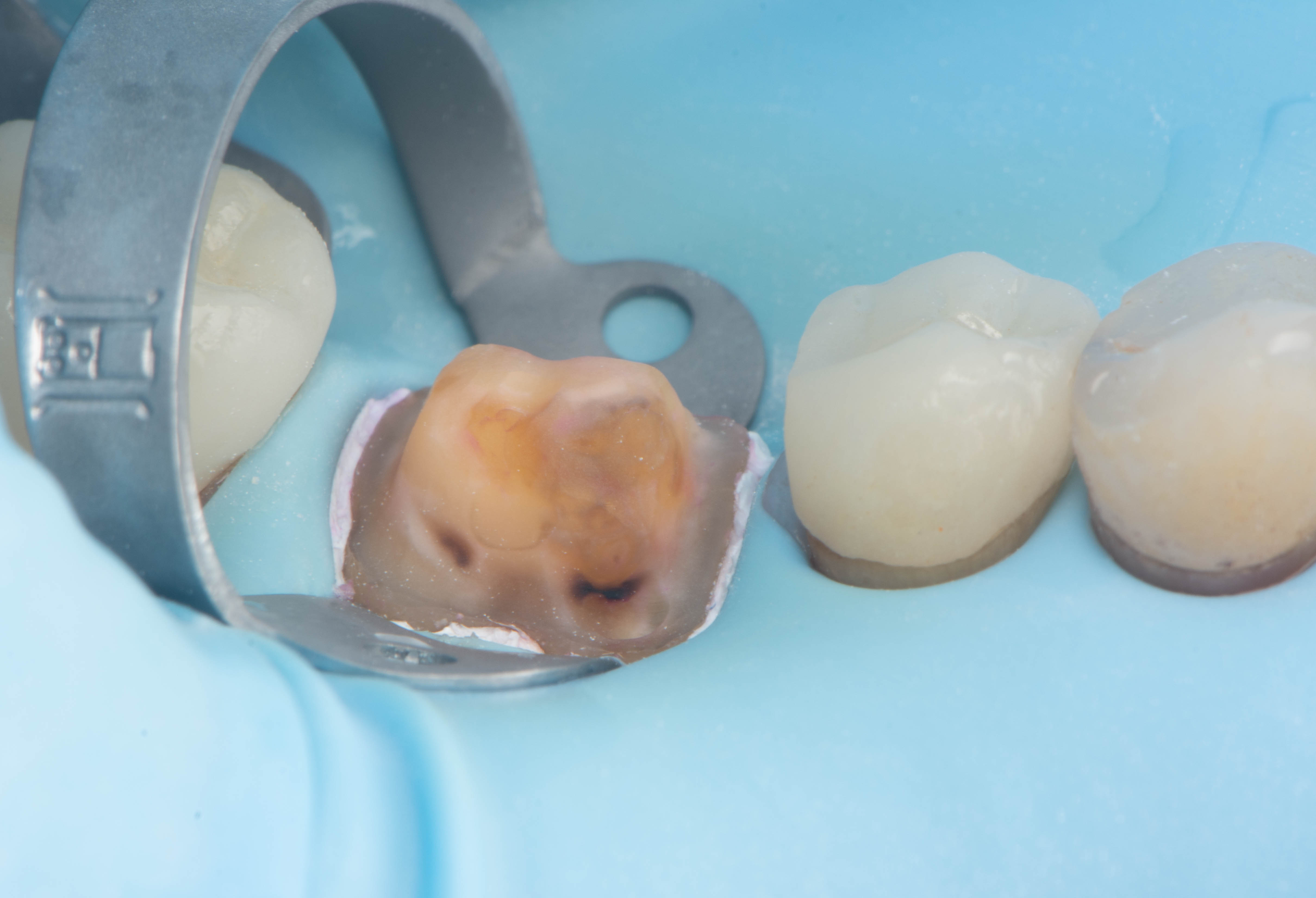 Tooth after compromised material was removed