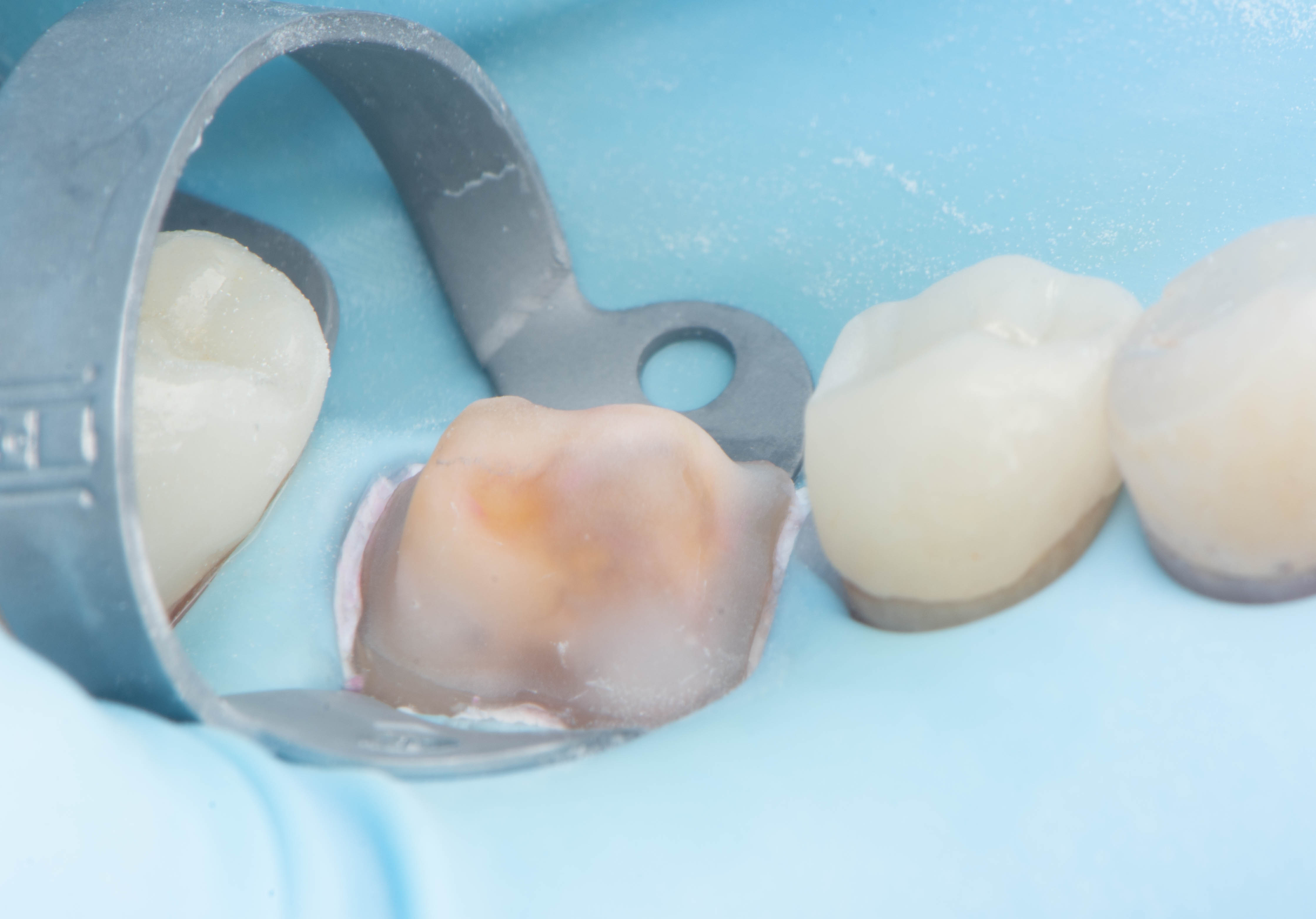 Tooth adhesively sealed and rebuilt