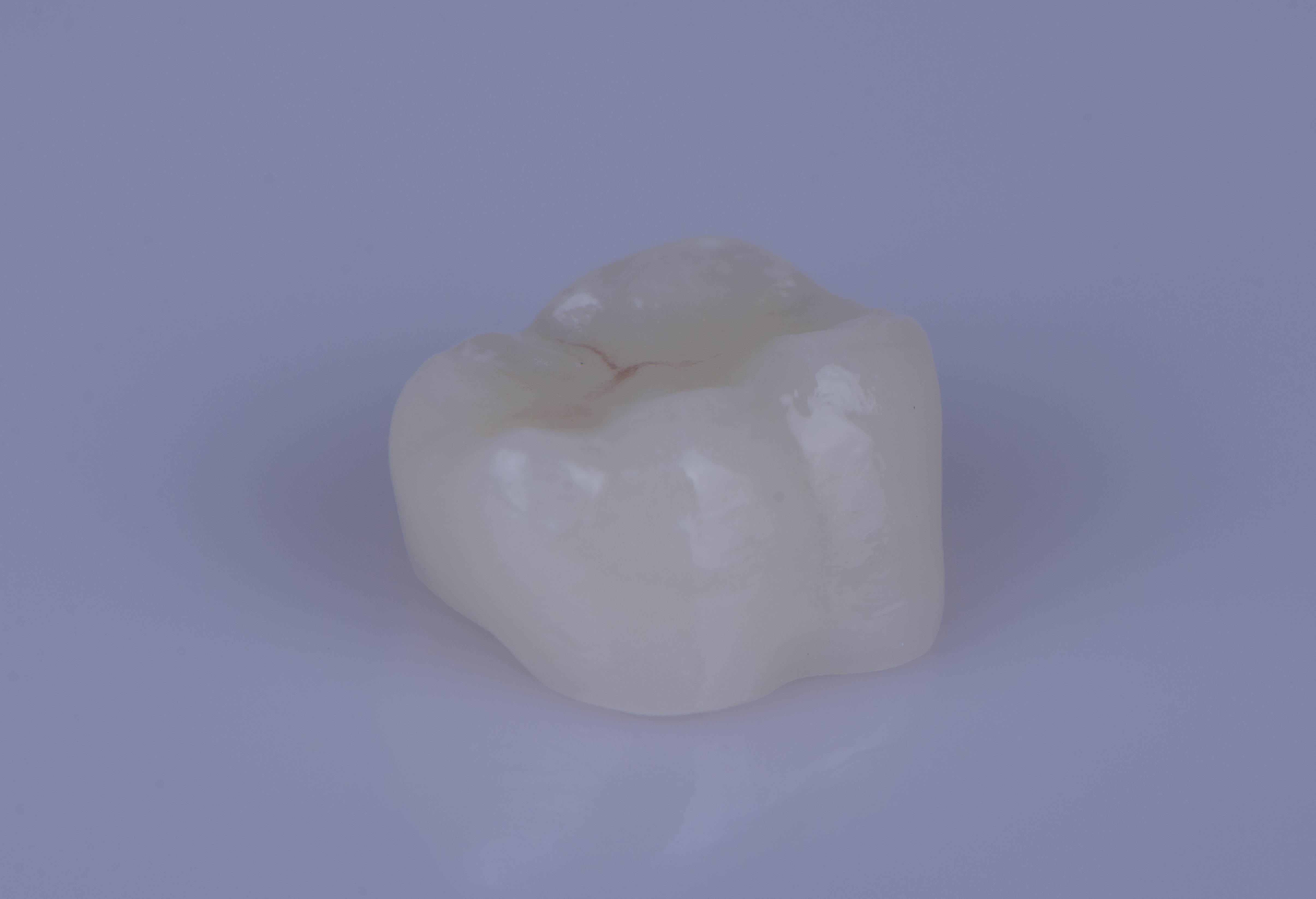 Conservative ceramic restoration before bonding
