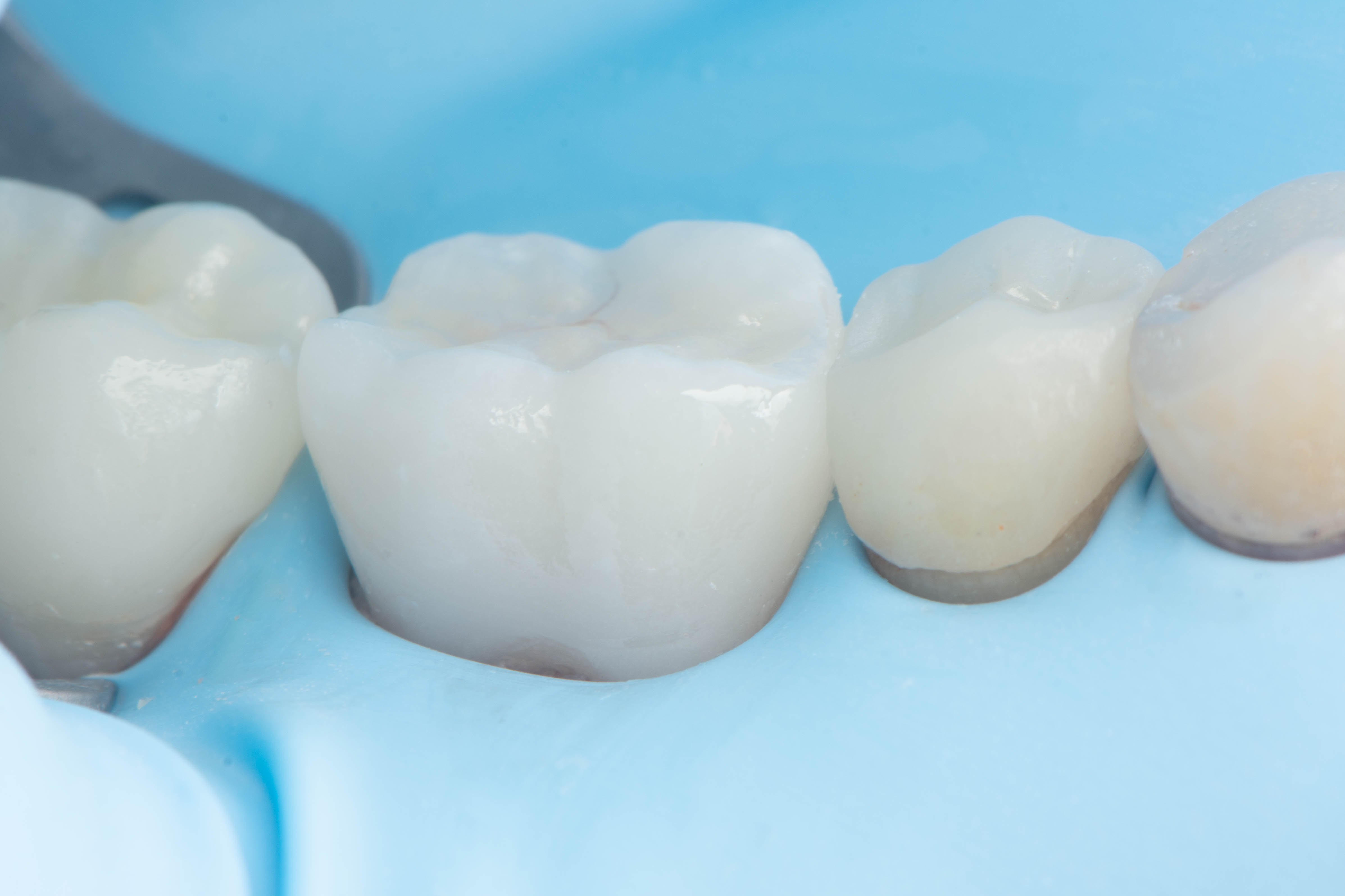 Final bonded ceramic restoration