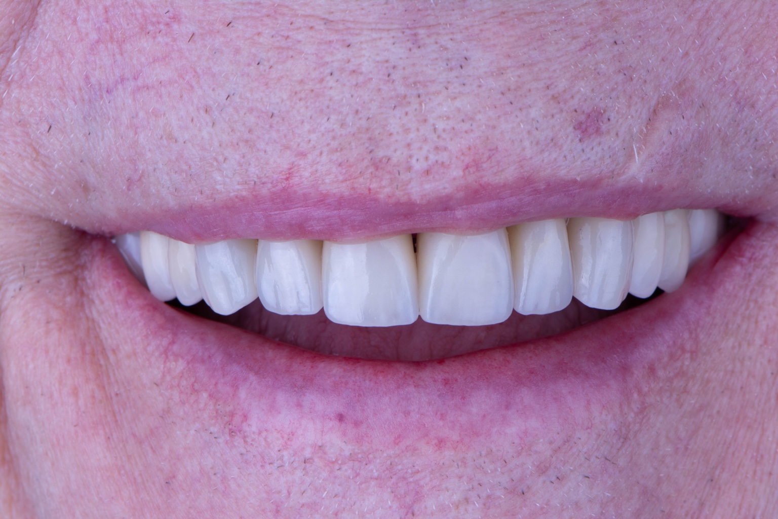 Cohesive natural-looking smile after biomimetic treatment