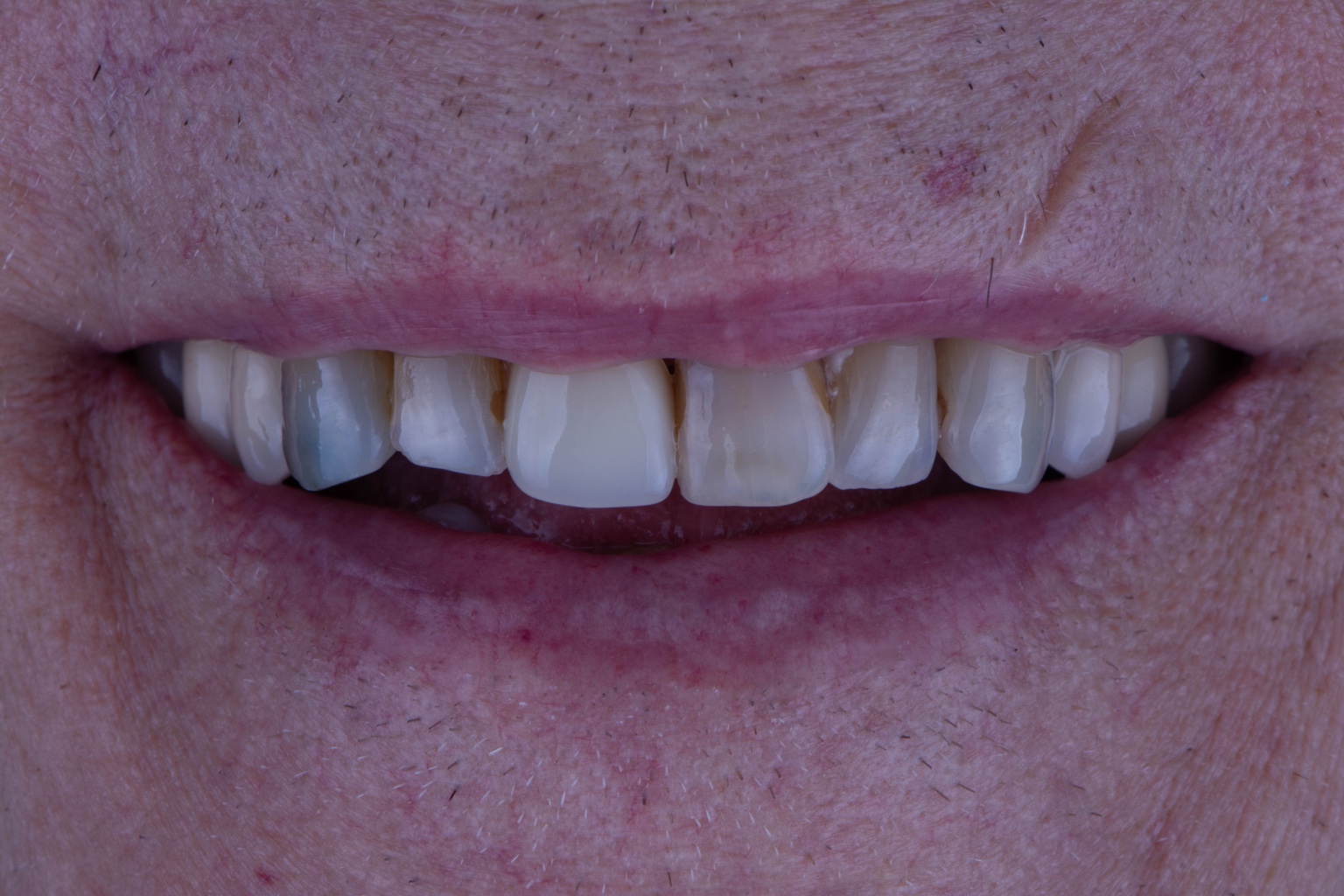 Years of mismatched dental work before biomimetic treatment