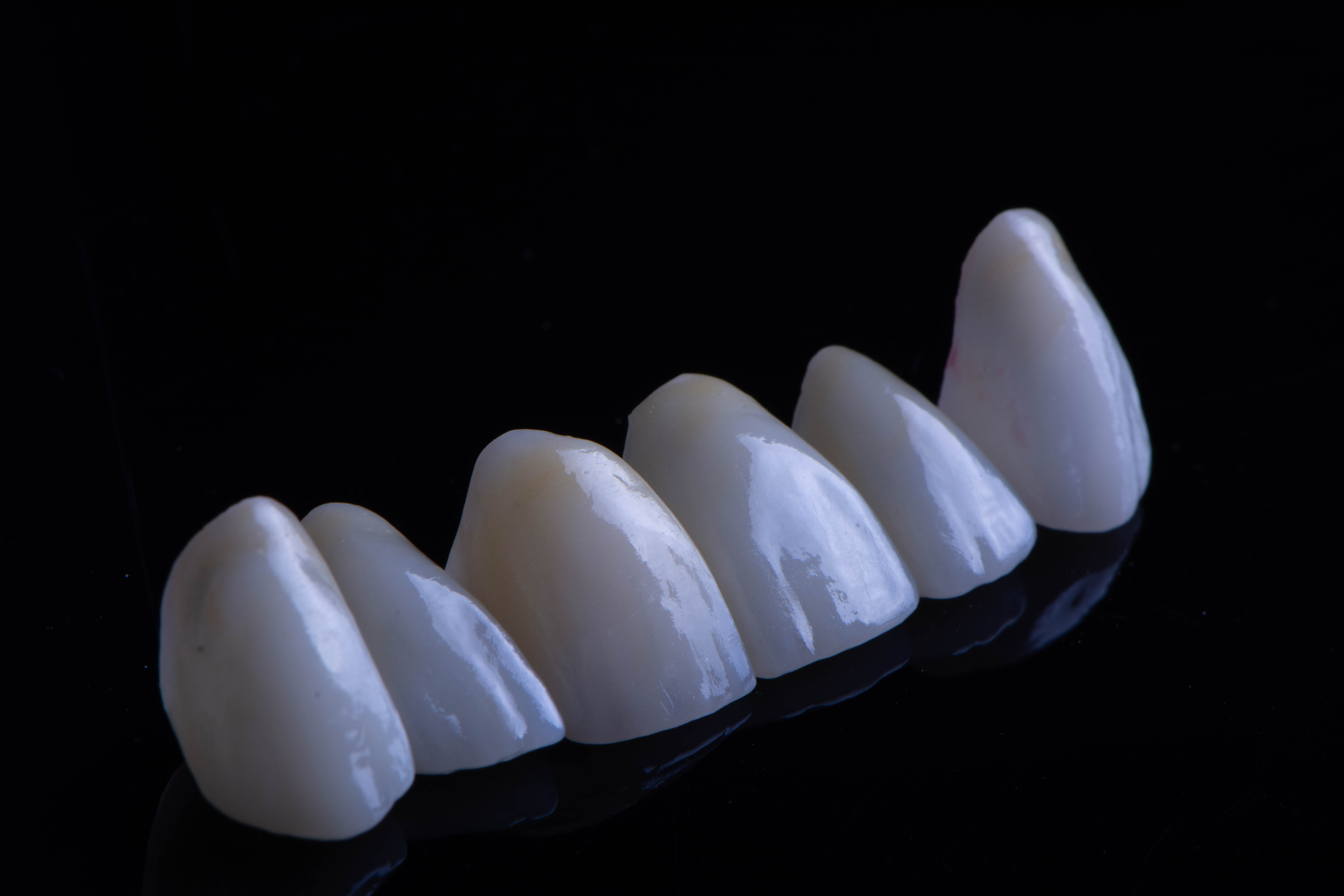 Custom bonded restorations designed as a cohesive set