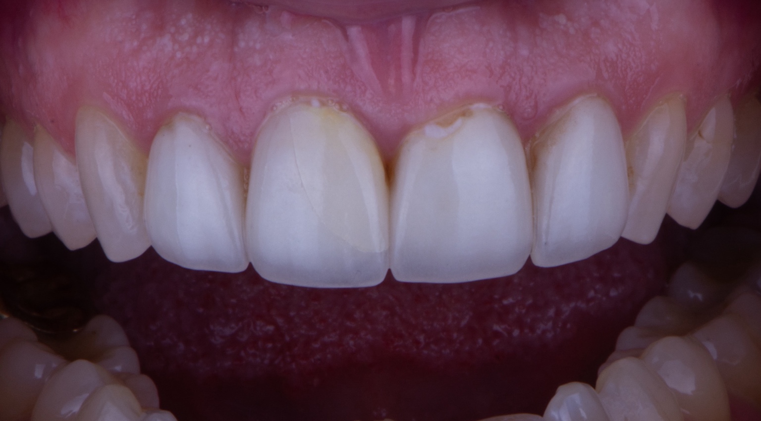 Failing cosmetic dental work before biomimetic treatment