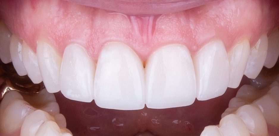 Completed natural-looking smile restoration