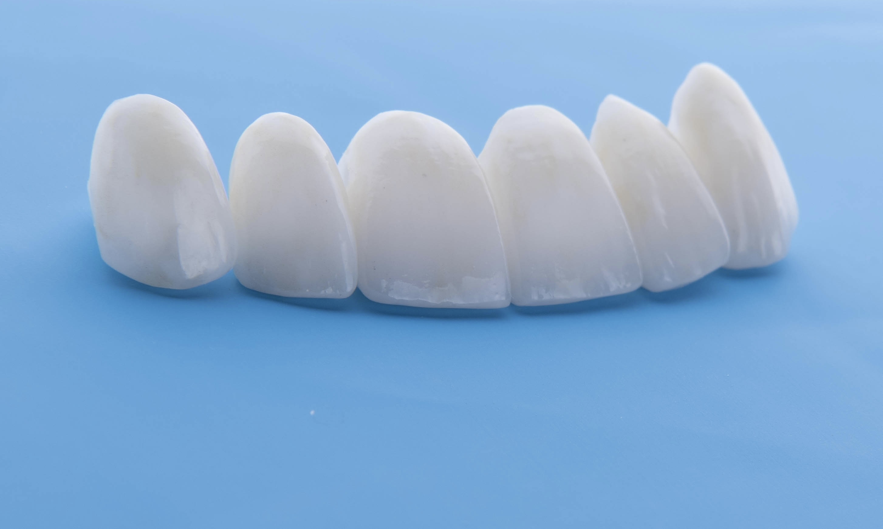 A series of natural-looking porcelain restorations