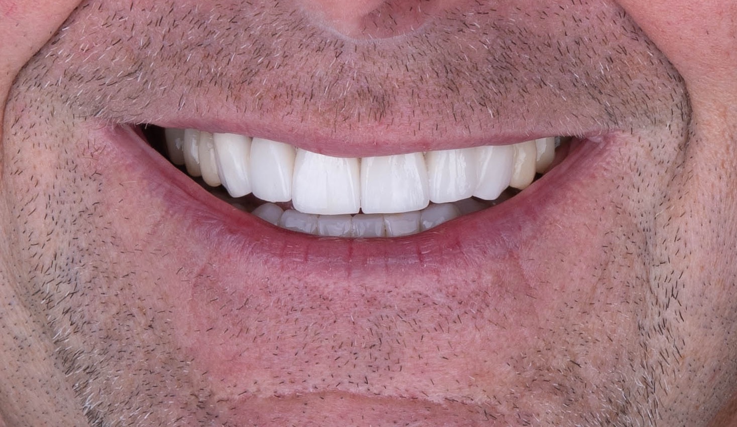 Completed smile after conservative ceramic restoration