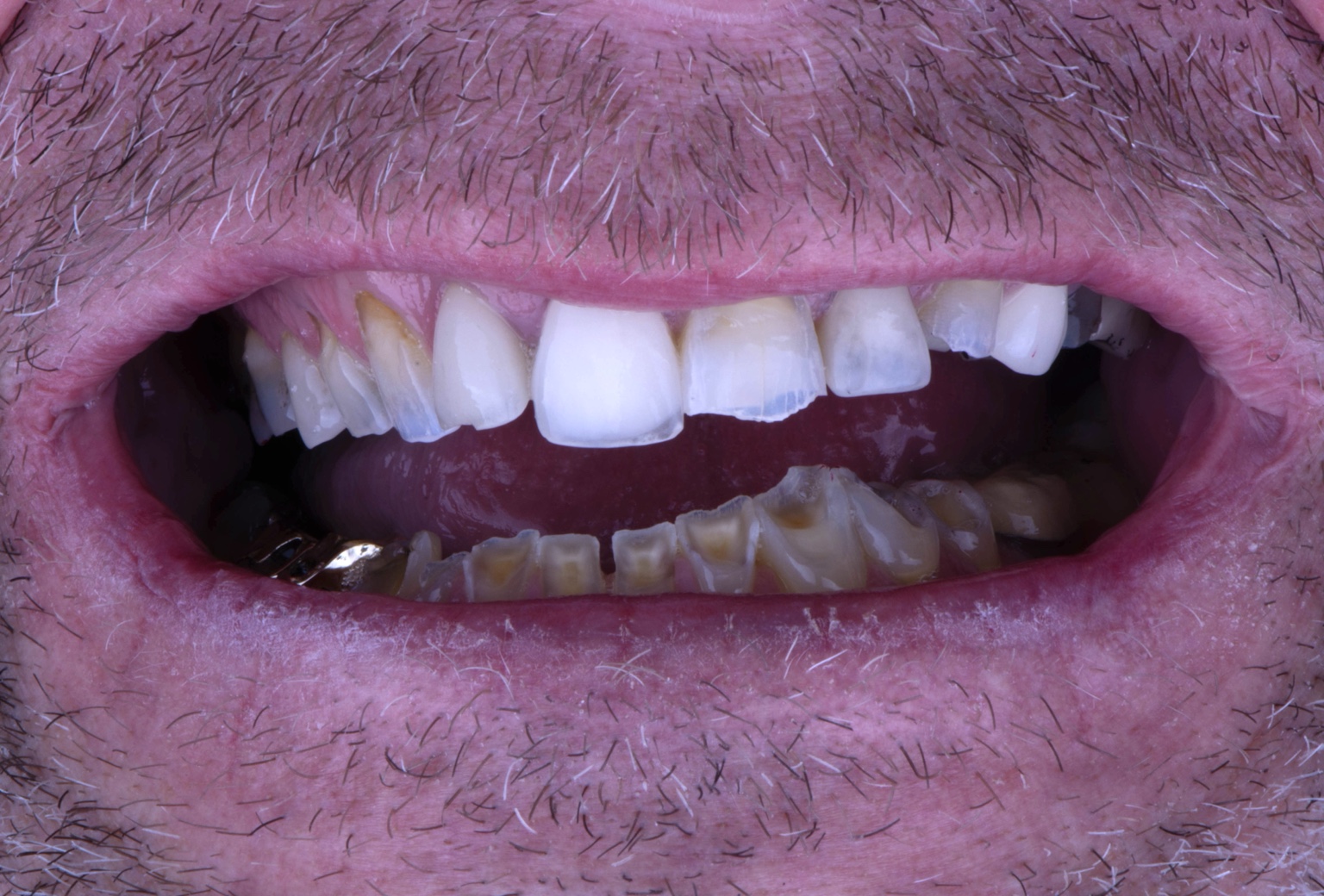 Worn and shortened teeth before conservative restorative treatment