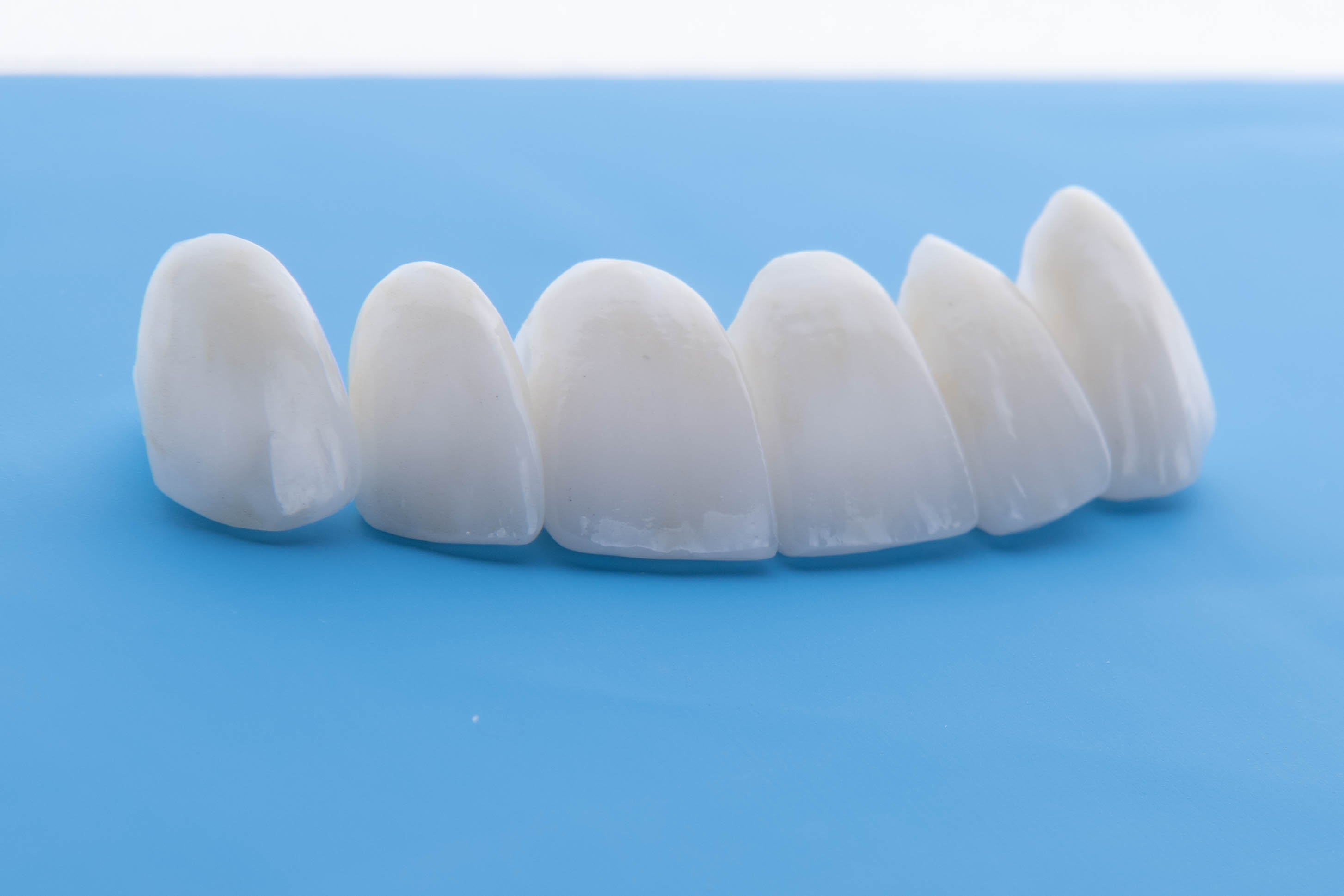 Conservative ceramic restorations created to replace lost tooth structure